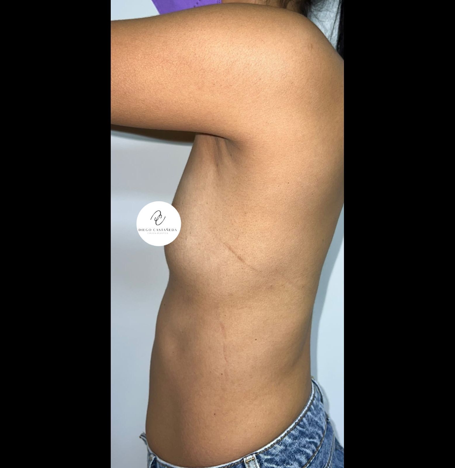 Mamoplastia – antes del procedimiento | Dr. Alejandro Lozano, cirujano plástico en Neiva