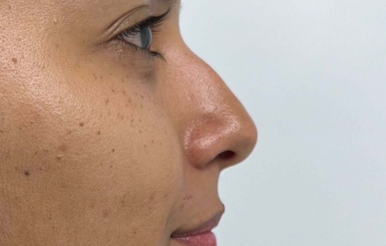 Rinoplastia Estética, Estructural y Funcional – antes del procedimiento | Dr. Alejandro Lozano, cirujano plástico en Neiva