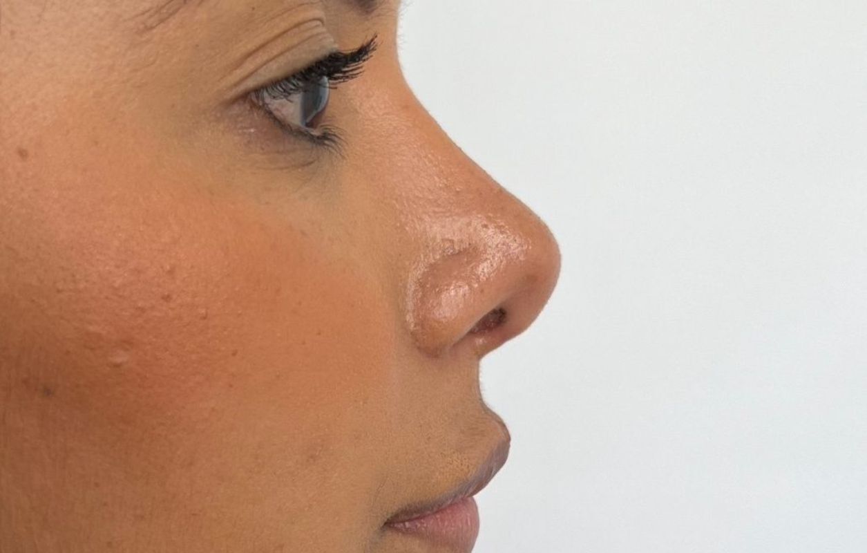 Rinoplastia Estética, Estructural y Funcional – después del procedimiento | Dr. Alejandro Lozano, cirujano plástico en Neiva