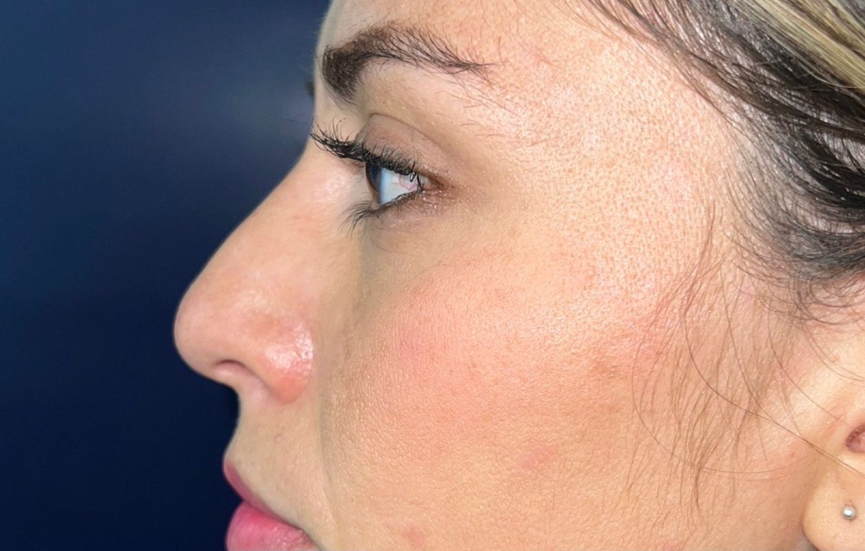 Rinoplastia Estética, Estructural y Funcional – antes del procedimiento | Dr. Alejandro Lozano, cirujano plástico en Neiva