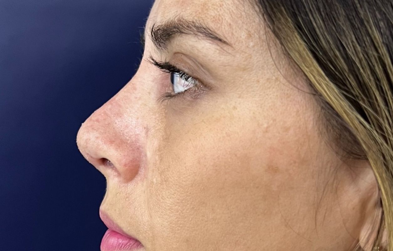 Rinoplastia Estética, Estructural y Funcional – después del procedimiento | Dr. Alejandro Lozano, cirujano plástico en Neiva