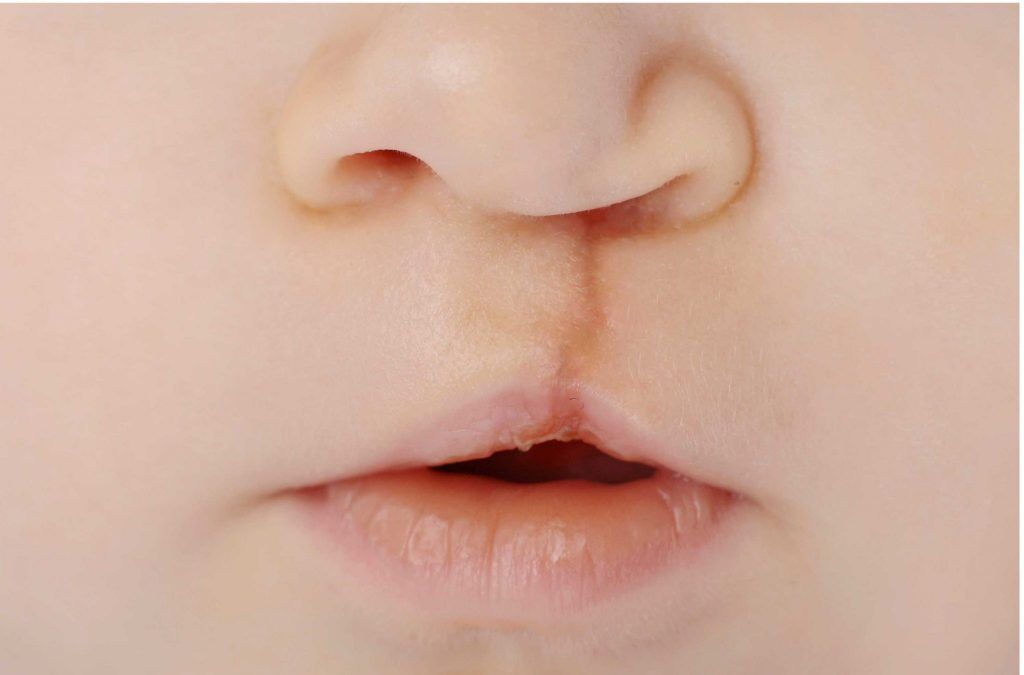 Labio y paladar hendido | Dr. Alejandro Lozano, cirujano plástico en Neiva