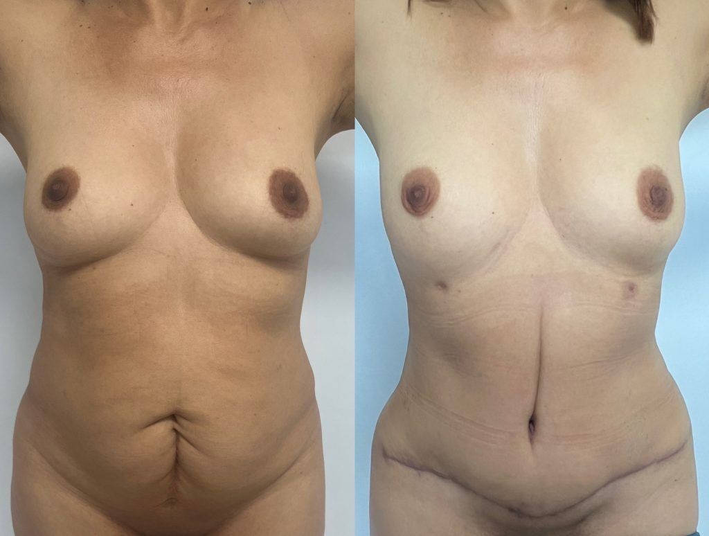 Abdominoplastia o lipectomía – resultado 5 | Dr. Alejandro Lozano, cirujano plástico en Neiva