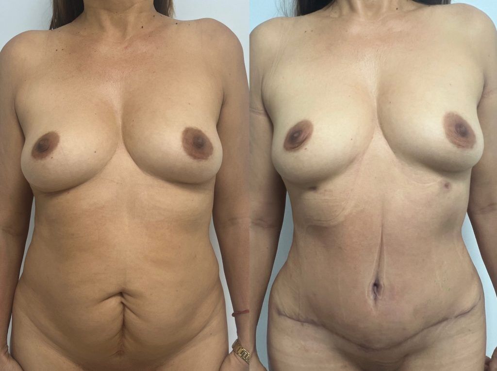 Abdominoplastia o lipectomía – resultado 4 | Dr. Alejandro Lozano, cirujano plástico en Neiva
