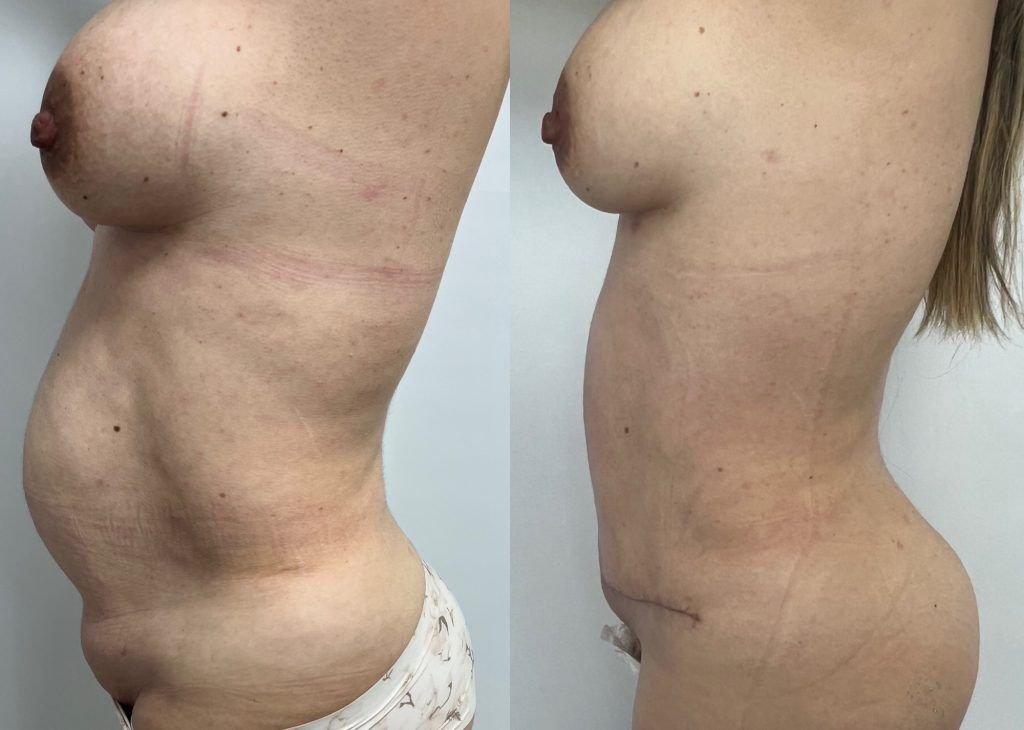 Abdominoplastia o lipectomía – resultado 3 | Dr. Alejandro Lozano, cirujano plástico en Neiva