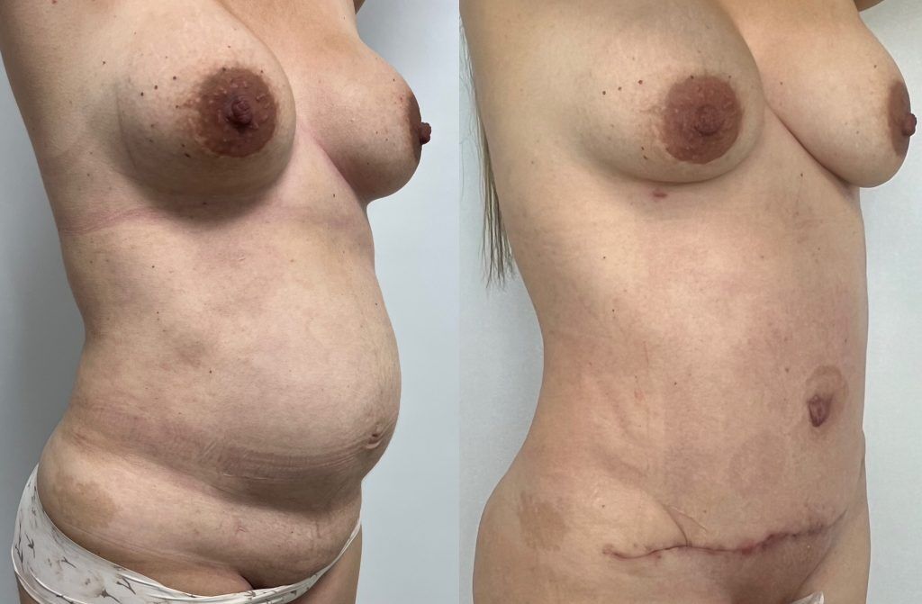 Abdominoplastia o lipectomía – resultado 2 | Dr. Alejandro Lozano, cirujano plástico en Neiva