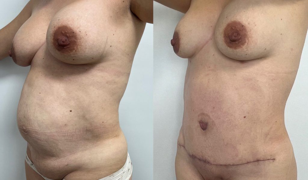 Abdominoplastia o lipectomía – resultado 1 | Dr. Alejandro Lozano, cirujano plástico en Neiva