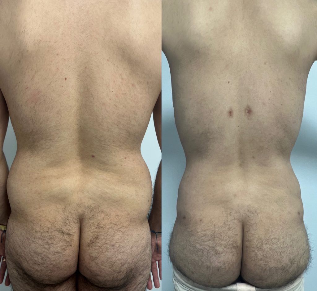 Lipoescultura o Liposucción – resultado 7 | Dr. Alejandro Lozano, cirujano plástico en Neiva
