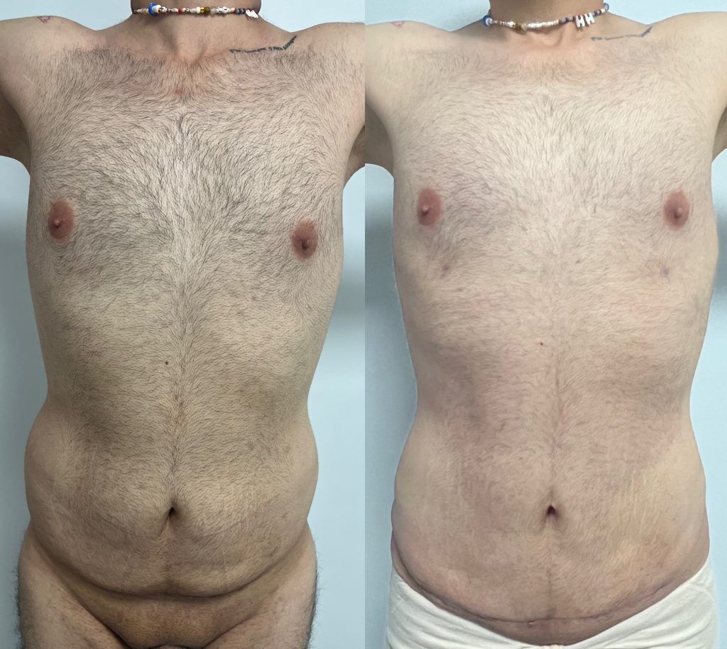 Lipoescultura o Liposucción – resultado 6 | Dr. Alejandro Lozano, cirujano plástico en Neiva