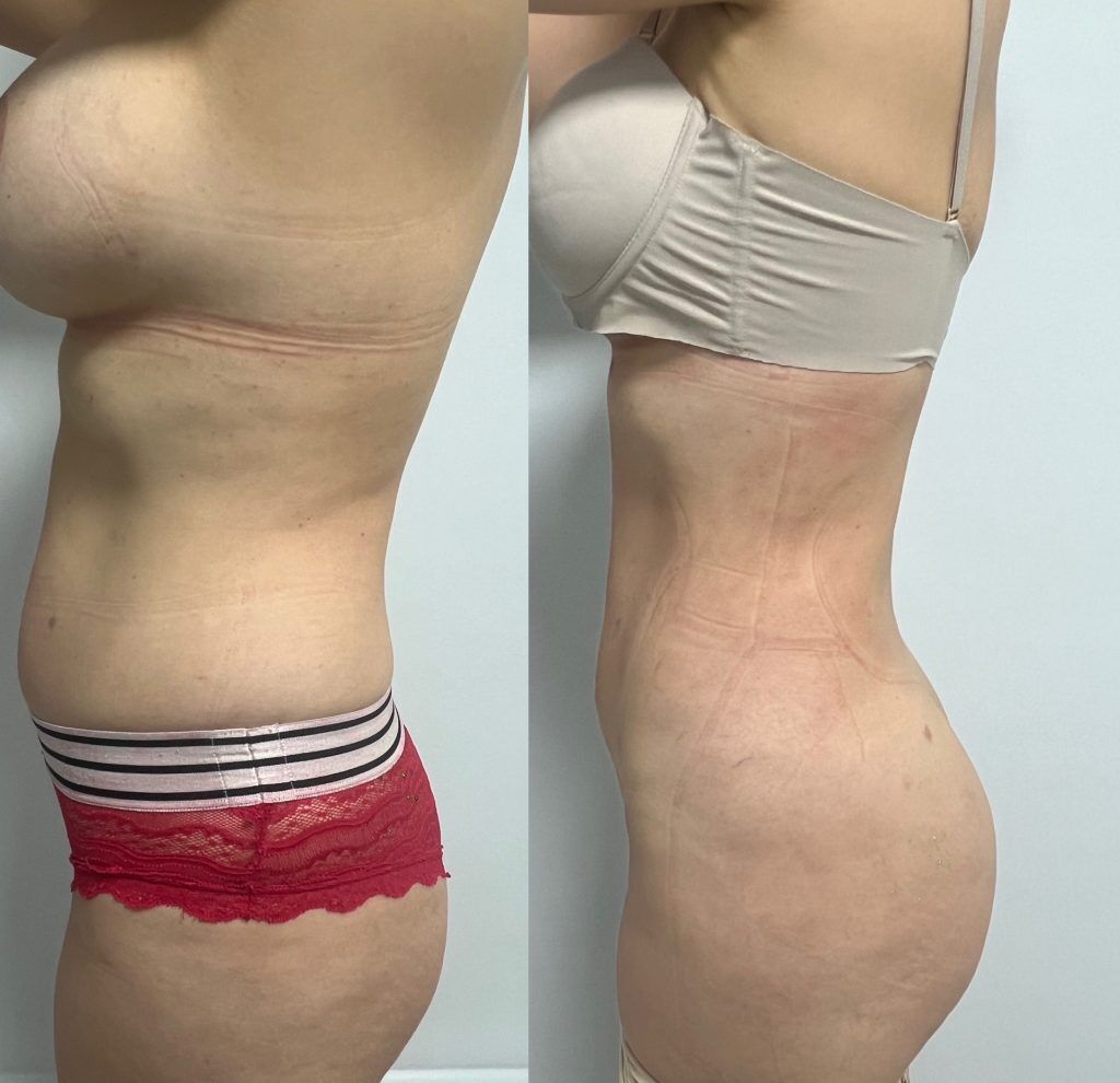 Lipoescultura o Liposucción – resultado 5 | Dr. Alejandro Lozano, cirujano plástico en Neiva