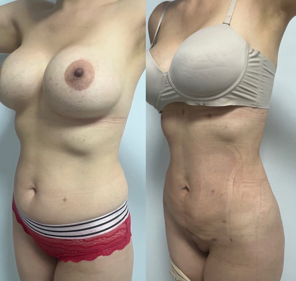 Lipoescultura o Liposucción – resultado 4 | Dr. Alejandro Lozano, cirujano plástico en Neiva