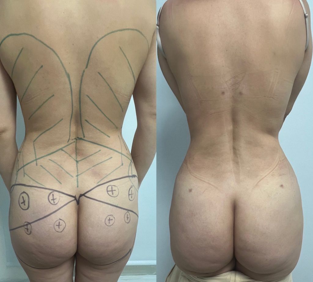 Lipoescultura o Liposucción – resultado 3 | Dr. Alejandro Lozano, cirujano plástico en Neiva
