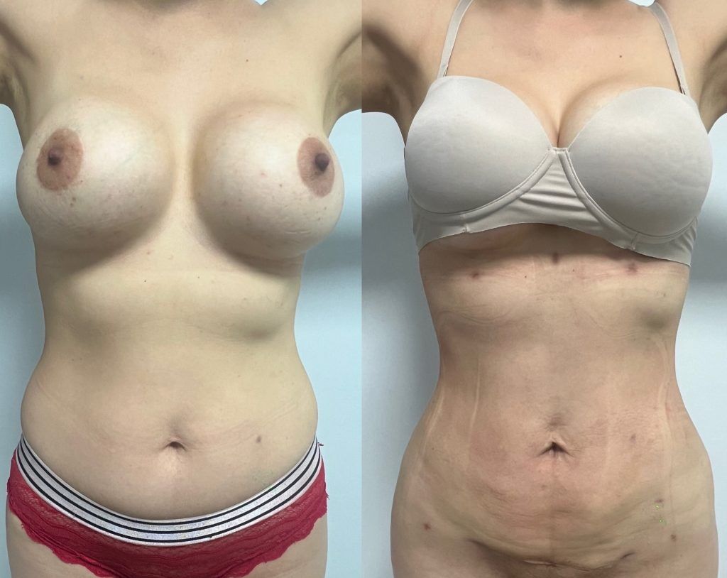Lipoescultura o Liposucción – resultado 2 | Dr. Alejandro Lozano, cirujano plástico en Neiva