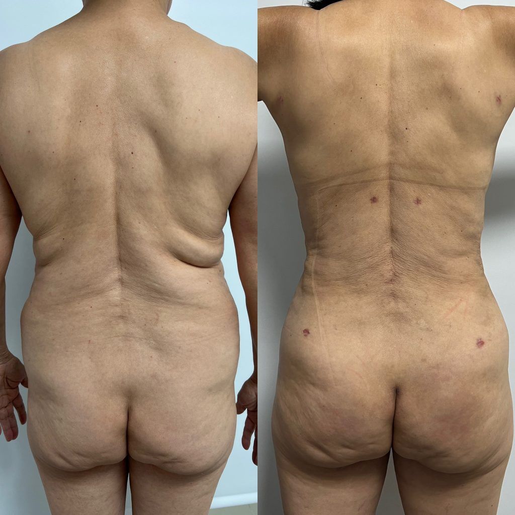 Lipoescultura o Liposucción – resultado 1 | Dr. Alejandro Lozano, cirujano plástico en Neiva