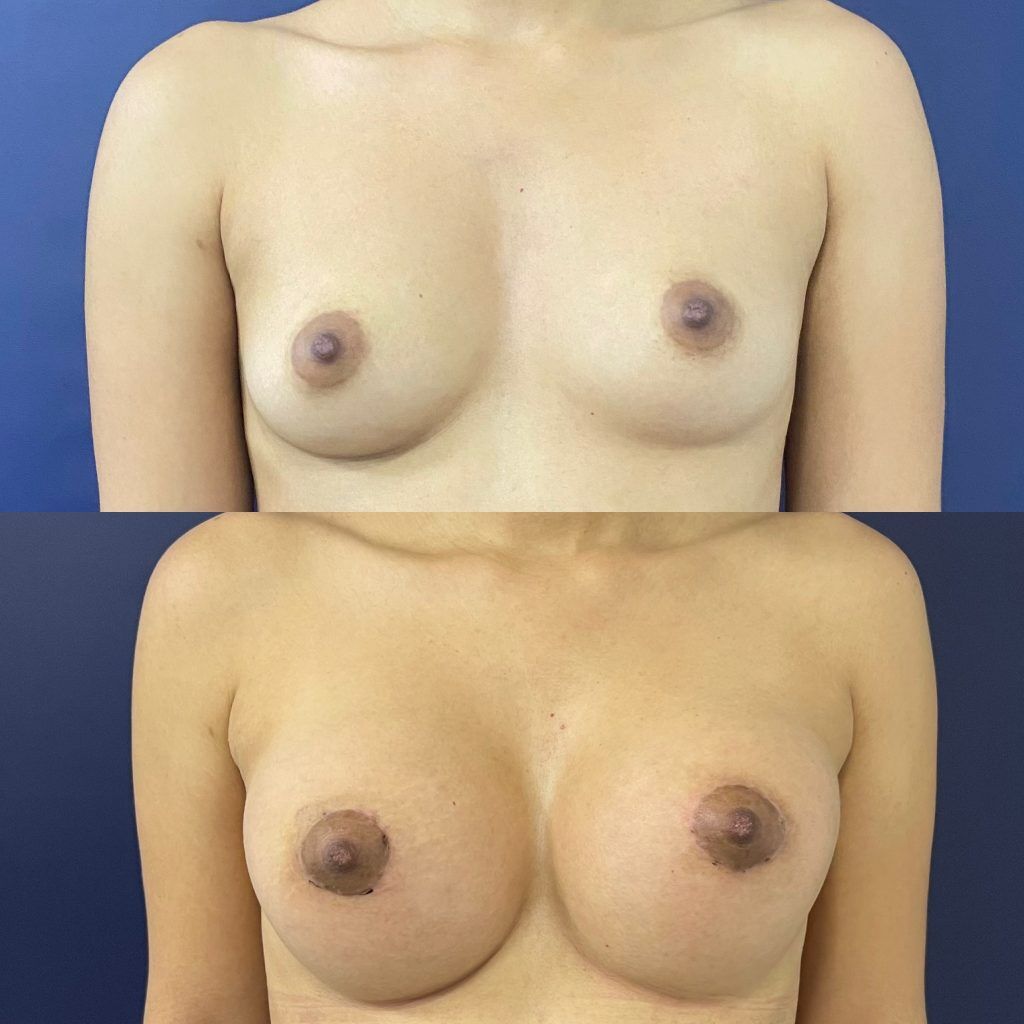 Mamoplastia – resultado 3 | Dr. Alejandro Lozano, cirujano plástico en Neiva
