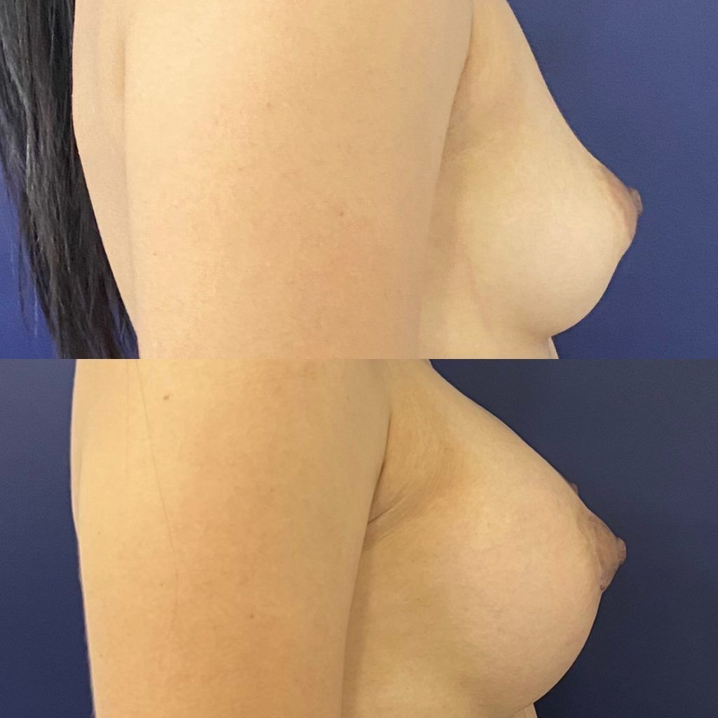 Mamoplastia – resultado 2 | Dr. Alejandro Lozano, cirujano plástico en Neiva