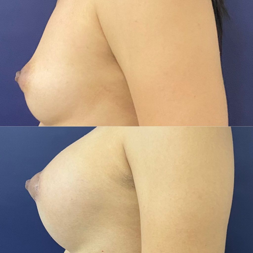 Mamoplastia – resultado 1 | Dr. Alejandro Lozano, cirujano plástico en Neiva