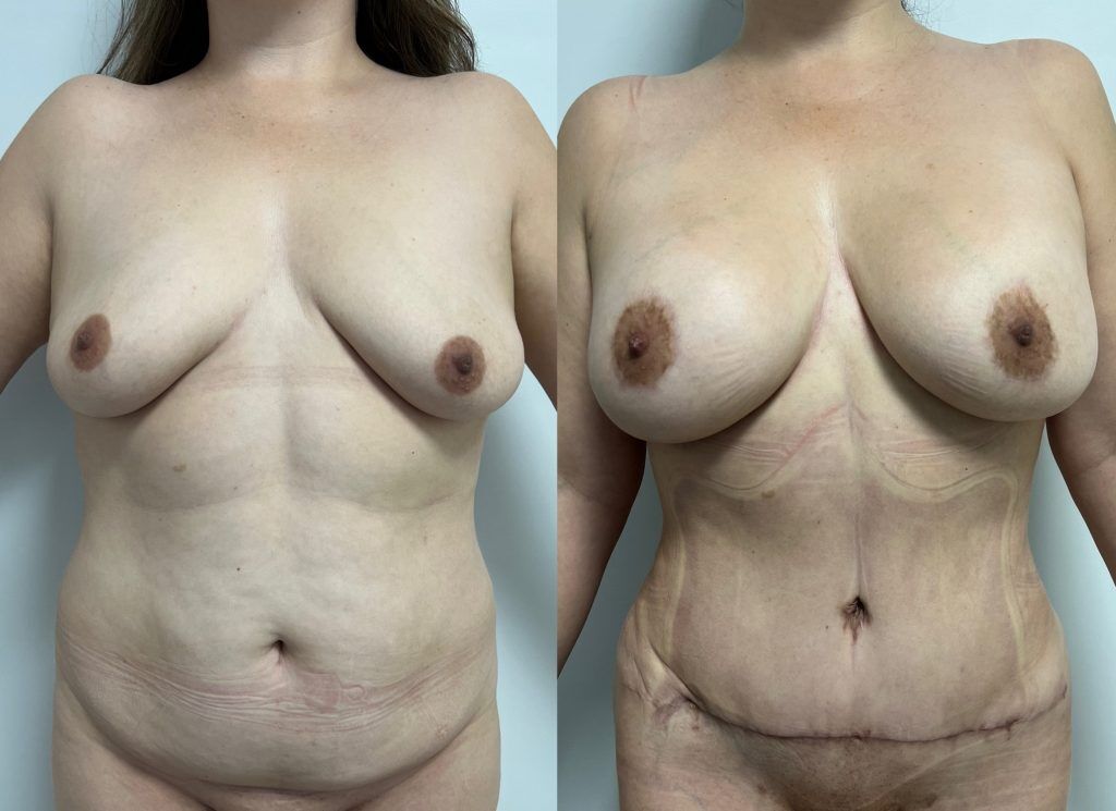 Rejuvenecimiento Corporal Post-Parto – resultado 5 | Dr. Alejandro Lozano, cirujano plástico en Neiva