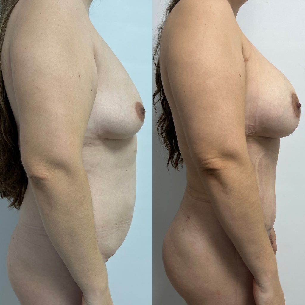 Rejuvenecimiento Corporal Post-Parto – resultado 4 | Dr. Alejandro Lozano, cirujano plástico en Neiva