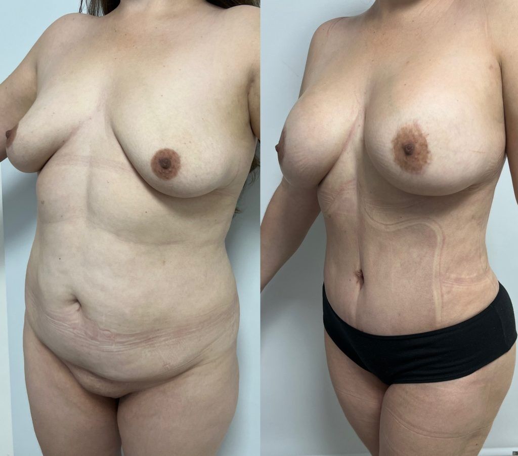 Rejuvenecimiento Corporal Post-Parto – resultado 3 | Dr. Alejandro Lozano, cirujano plástico en Neiva