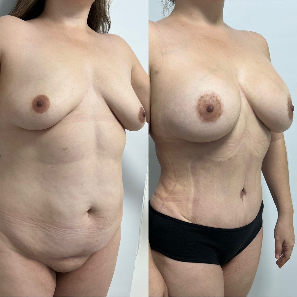 Rejuvenecimiento Corporal Post-Parto – resultado 2 | Dr. Alejandro Lozano, cirujano plástico en Neiva
