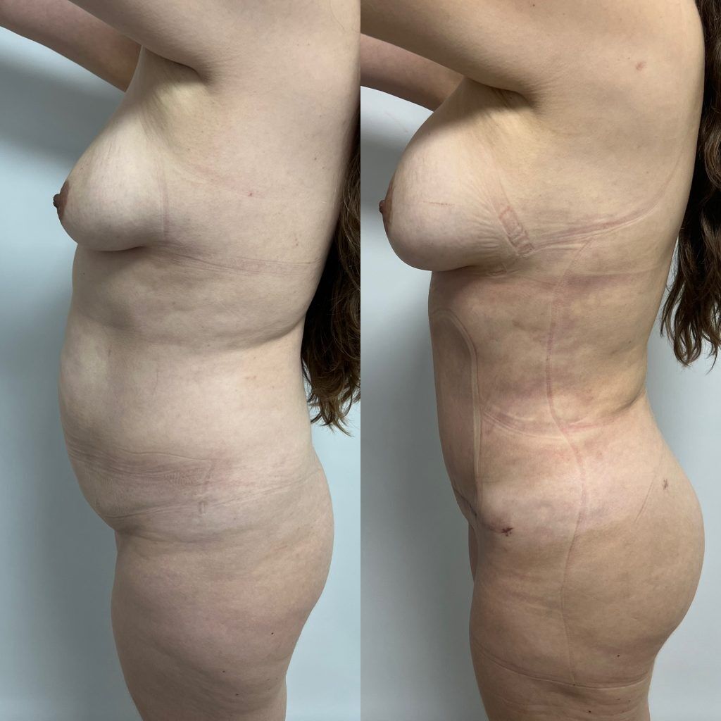 Rejuvenecimiento Corporal Post-Parto – resultado 1 | Dr. Alejandro Lozano, cirujano plástico en Neiva
