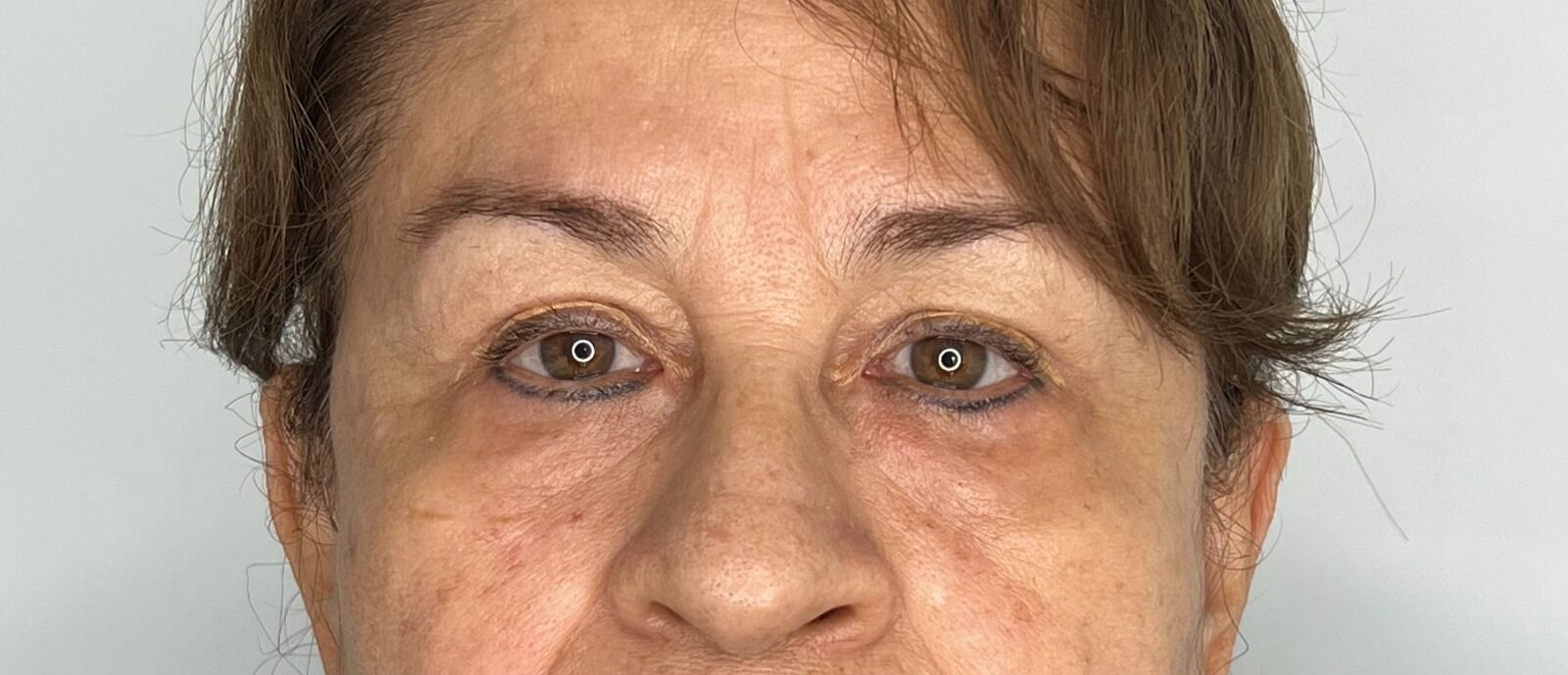Blefaroplastia o Cirugía de Párpados – después del procedimiento | Dr. Alejandro Lozano, cirujano plástico en Neiva
