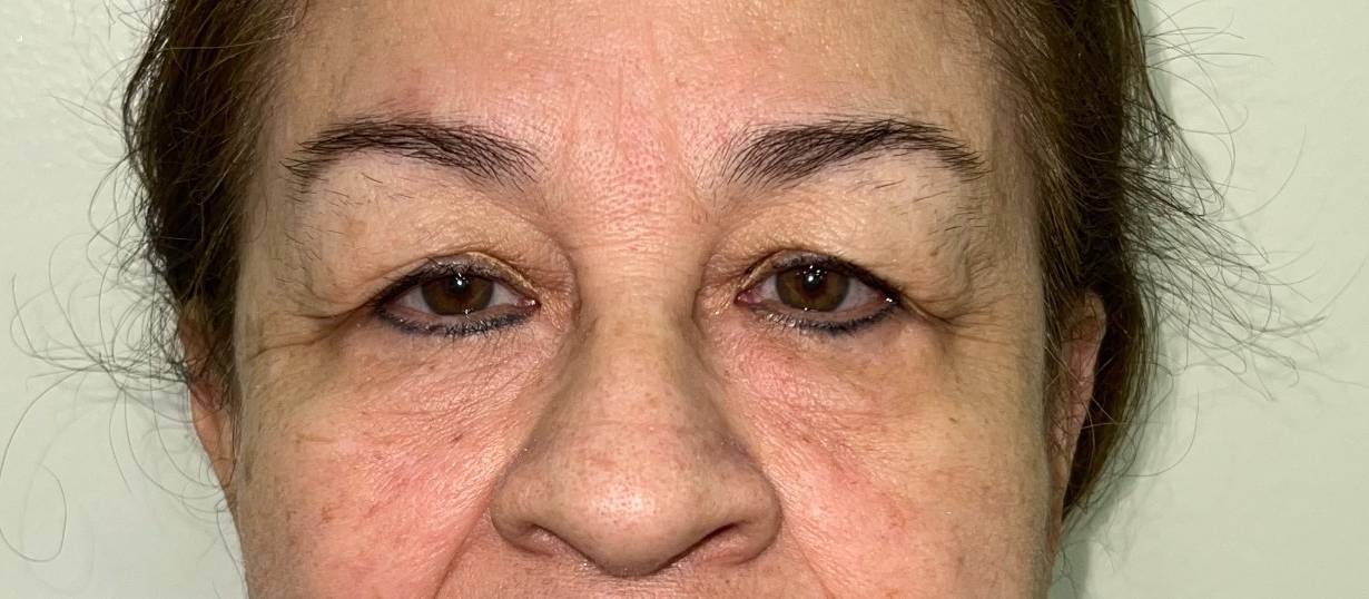 Blefaroplastia o Cirugía de Párpados – antes del procedimiento | Dr. Alejandro Lozano, cirujano plástico en Neiva