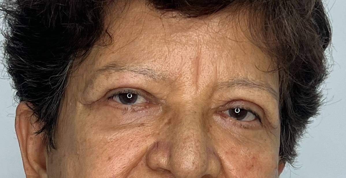 Blefaroplastia o Cirugía de Párpados – después del procedimiento | Dr. Alejandro Lozano, cirujano plástico en Neiva