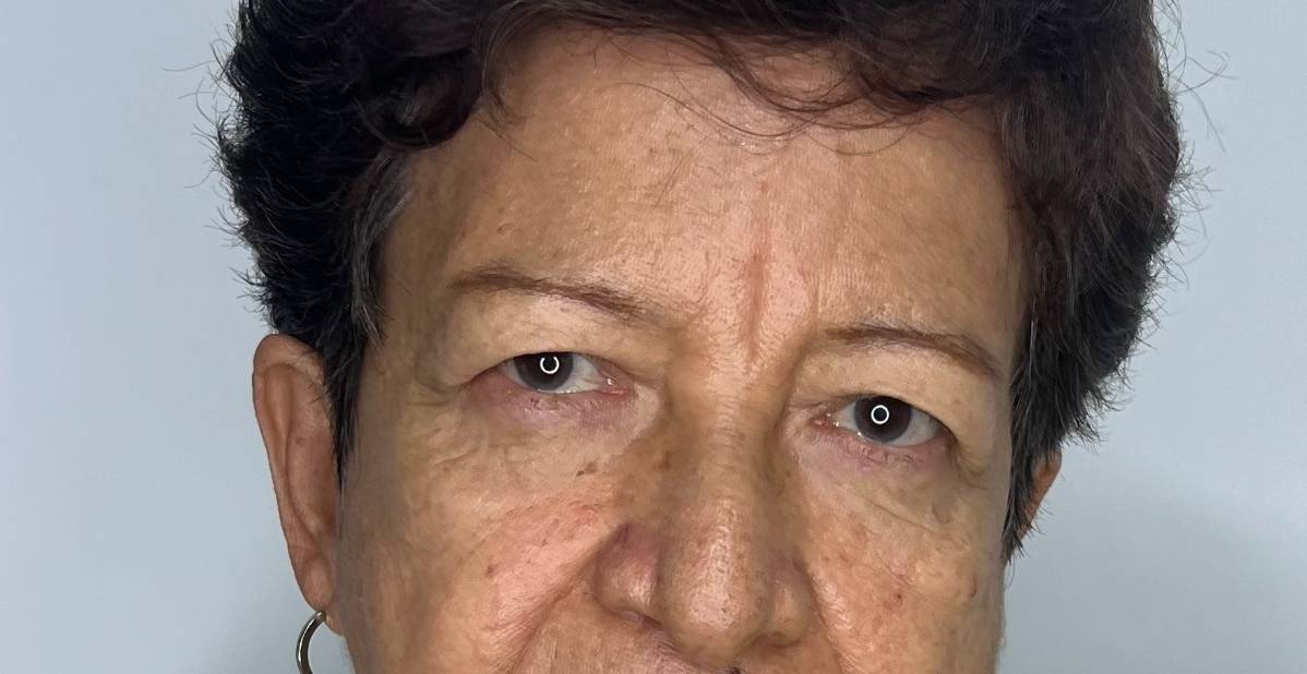 Blefaroplastia o Cirugía de Párpados – antes del procedimiento | Dr. Alejandro Lozano, cirujano plástico en Neiva