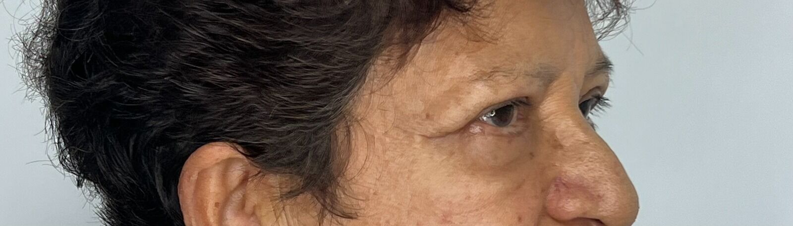 Blefaroplastia o Cirugía de Párpados – después del procedimiento | Dr. Alejandro Lozano, cirujano plástico en Neiva