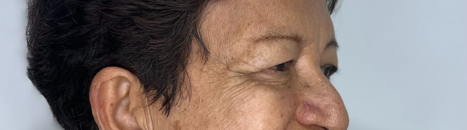 Blefaroplastia o Cirugía de Párpados – antes del procedimiento | Dr. Alejandro Lozano, cirujano plástico en Neiva
