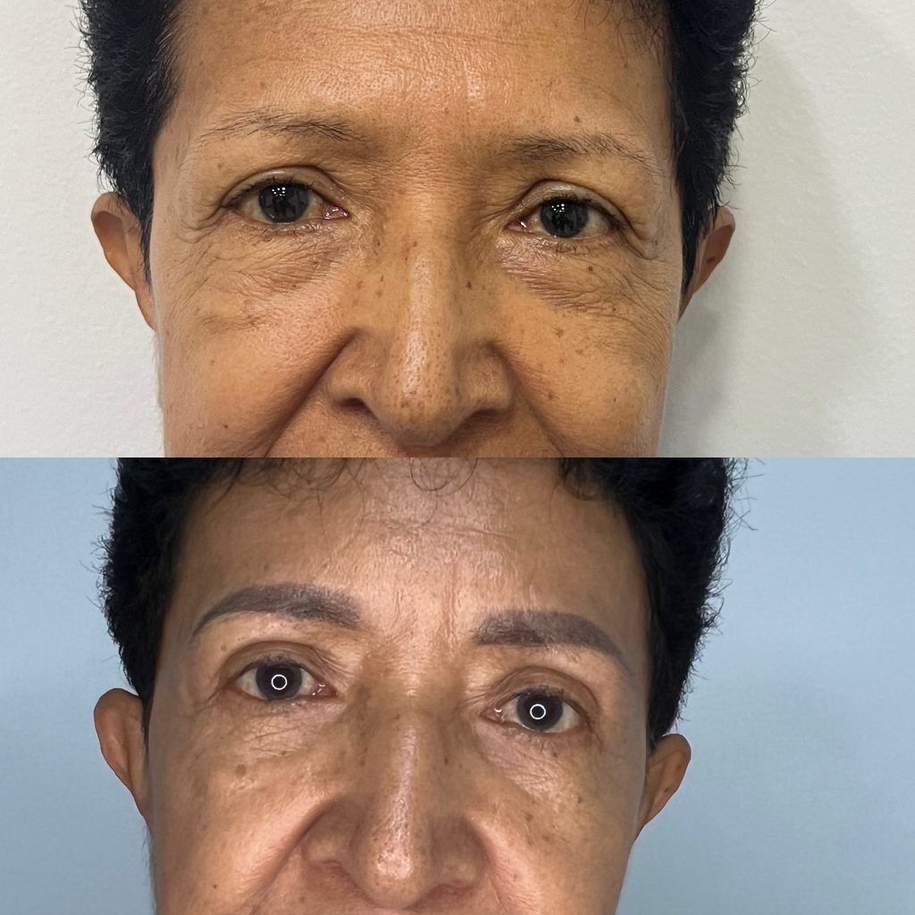 Blefaroplastia o Cirugía de Párpados – antes y después, foto 1 | Dr. Alejandro Lozano, cirujano plástico en Neiva
