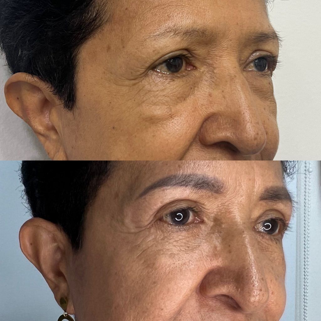 Blefaroplastia o Cirugía de Párpados – antes y después, foto 2 | Dr. Alejandro Lozano, cirujano plástico en Neiva
