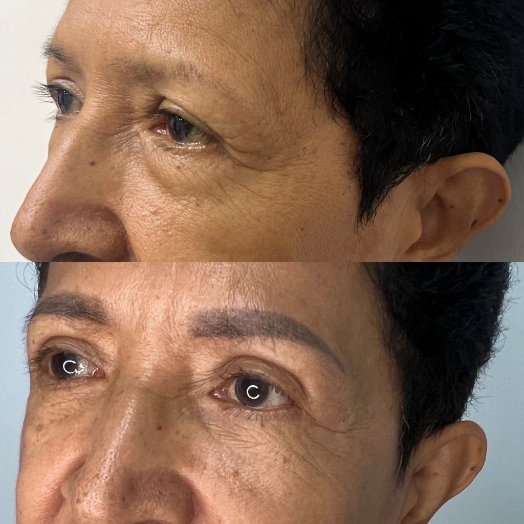 Blefaroplastia o Cirugía de Párpados – antes y después, foto 3 | Dr. Alejandro Lozano, cirujano plástico en Neiva