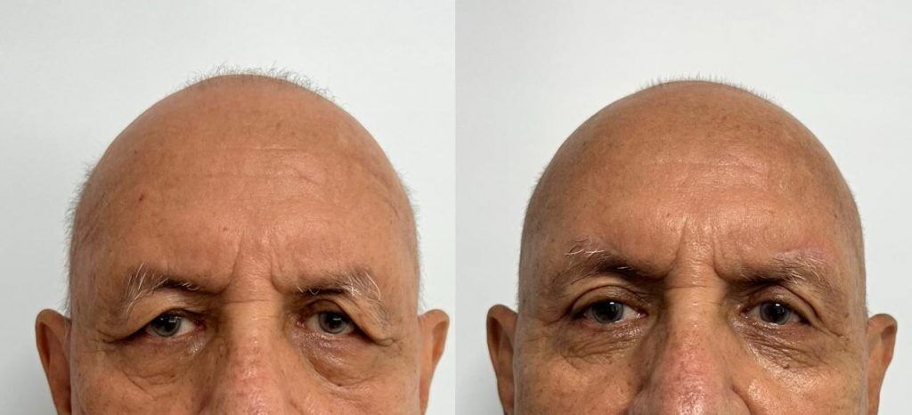Elevación de cola de ceja – antes y después, foto 3 | Dr. Alejandro Lozano, cirujano plástico en Neiva