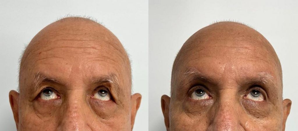 Elevación de cola de ceja – antes y después, foto 2 | Dr. Alejandro Lozano, cirujano plástico en Neiva