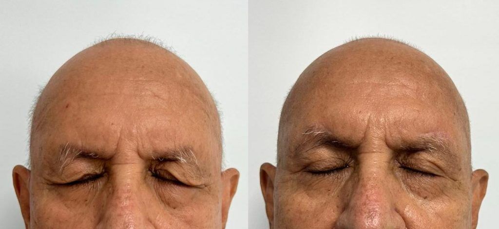 Elevación de cola de ceja – antes y después, foto 1 | Dr. Alejandro Lozano, cirujano plástico en Neiva