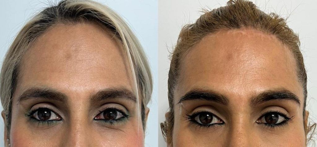 Frontoplastia – antes y después, foto 2 | Dr. Alejandro Lozano, cirujano plástico en Neiva
