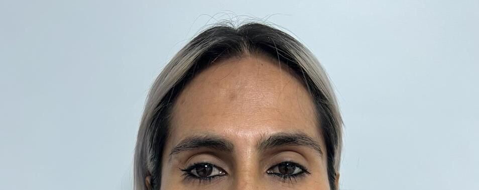 Frontoplastia – antes y después, foto 1 | Dr. Alejandro Lozano, cirujano plástico en Neiva