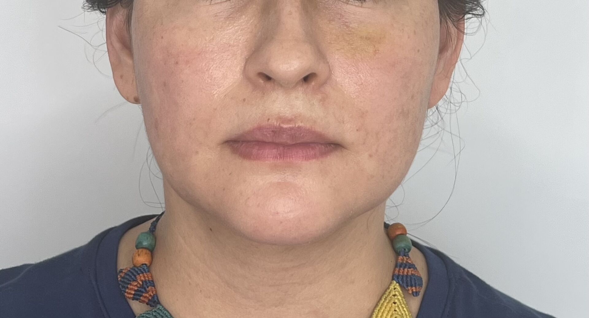 Mentoplastia – después del procedimiento | Dr. Alejandro Lozano, cirujano plástico en Neiva