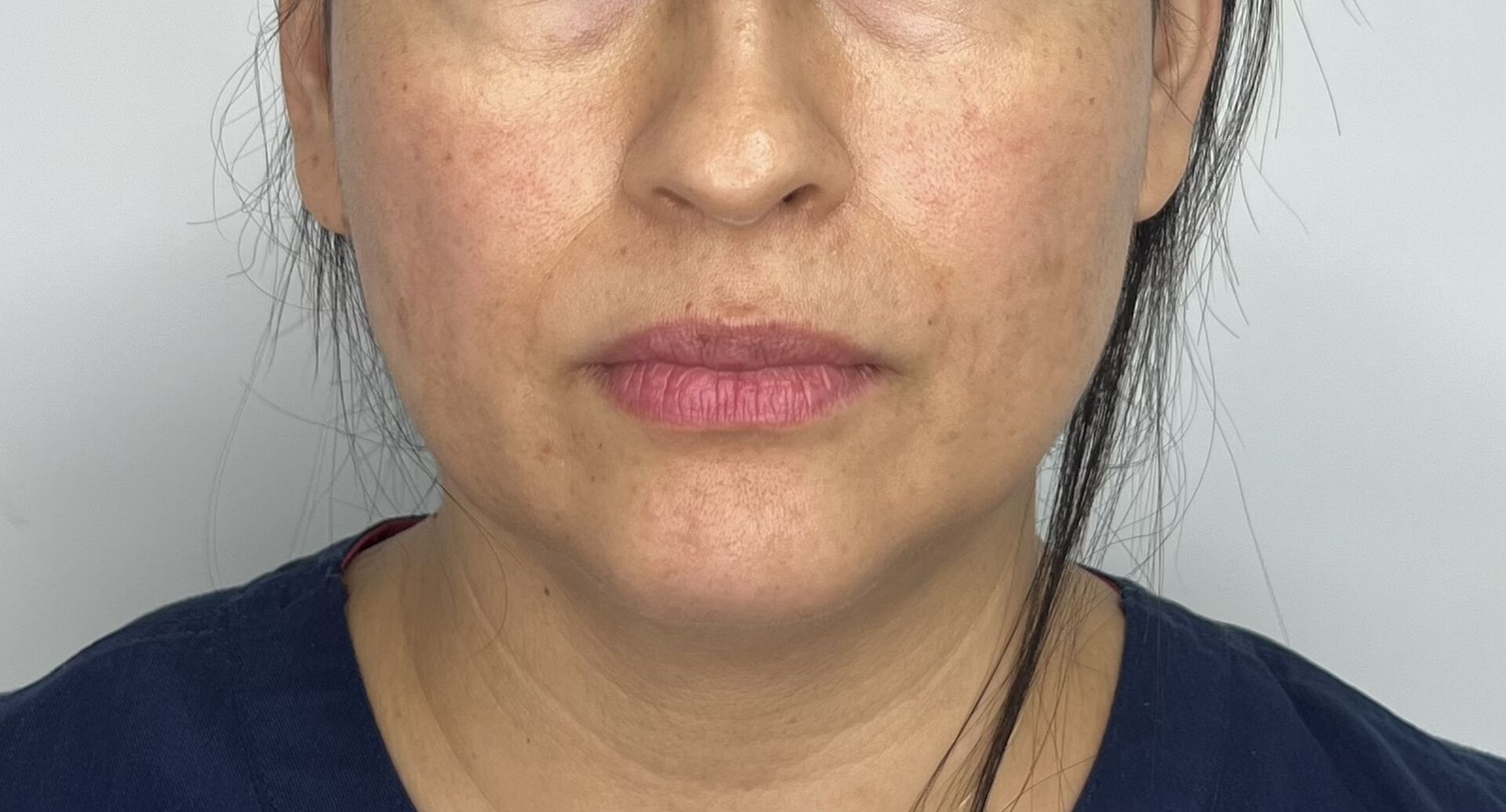 Mentoplastia – antes del procedimiento | Dr. Alejandro Lozano, cirujano plástico en Neiva