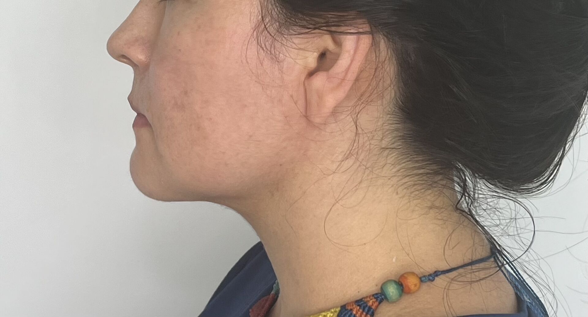 Mentoplastia – después del procedimiento | Dr. Alejandro Lozano, cirujano plástico en Neiva