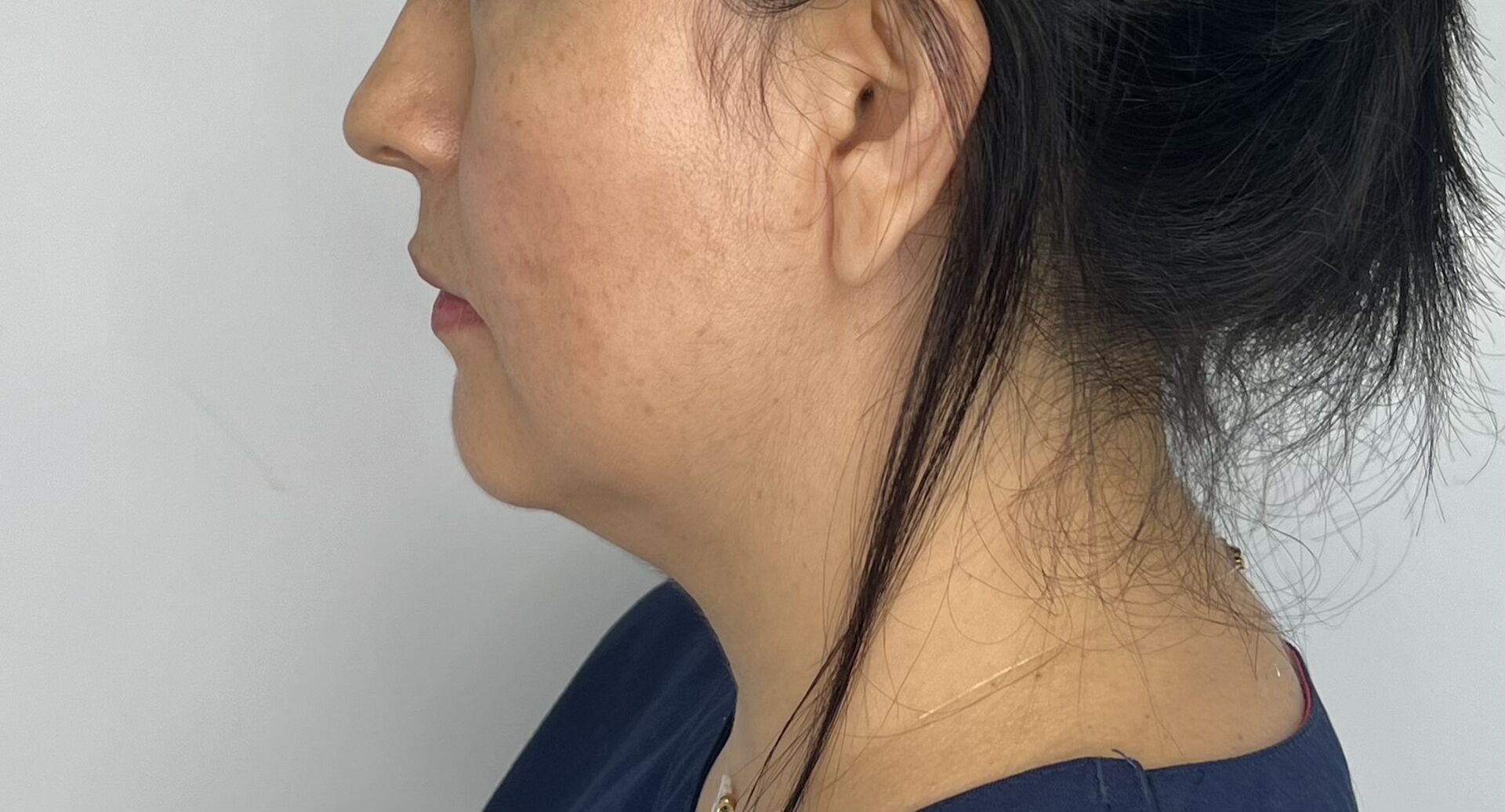 Mentoplastia – antes del procedimiento | Dr. Alejandro Lozano, cirujano plástico en Neiva