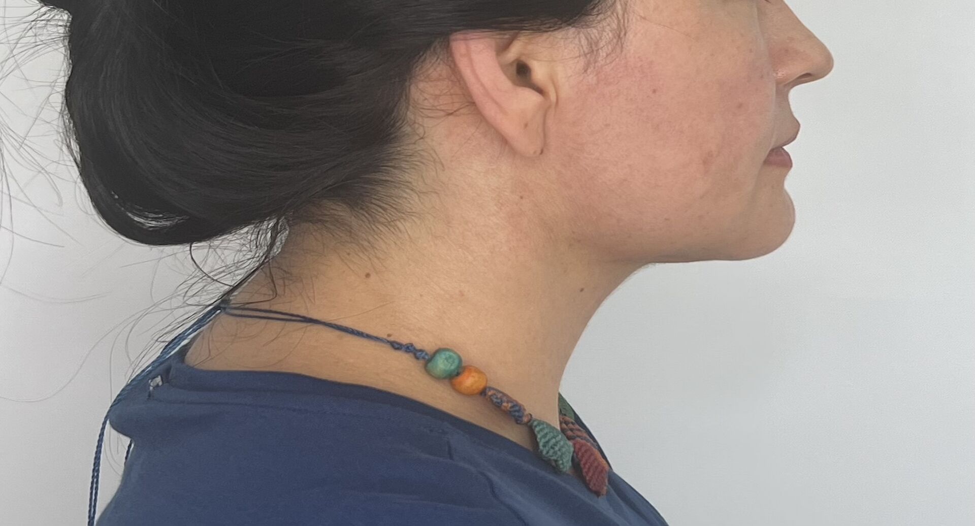 Mentoplastia – después del procedimiento | Dr. Alejandro Lozano, cirujano plástico en Neiva