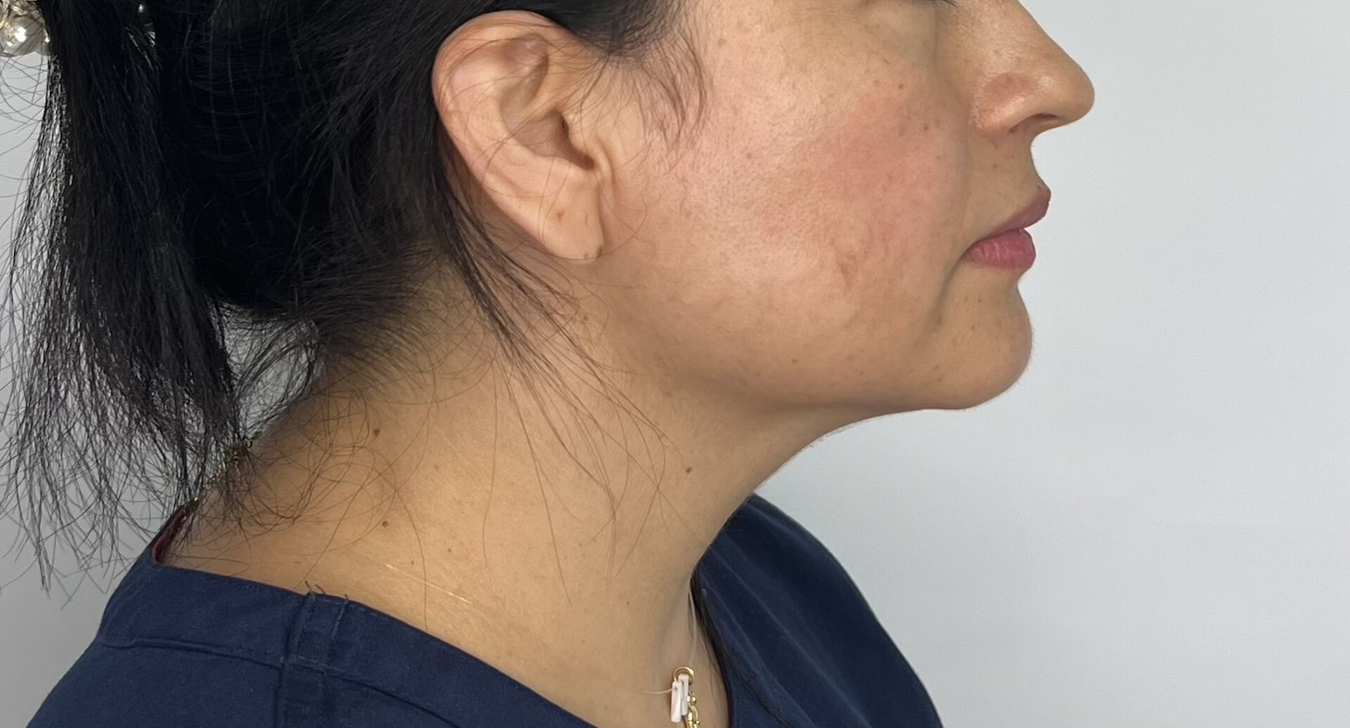 Mentoplastia – antes del procedimiento | Dr. Alejandro Lozano, cirujano plástico en Neiva