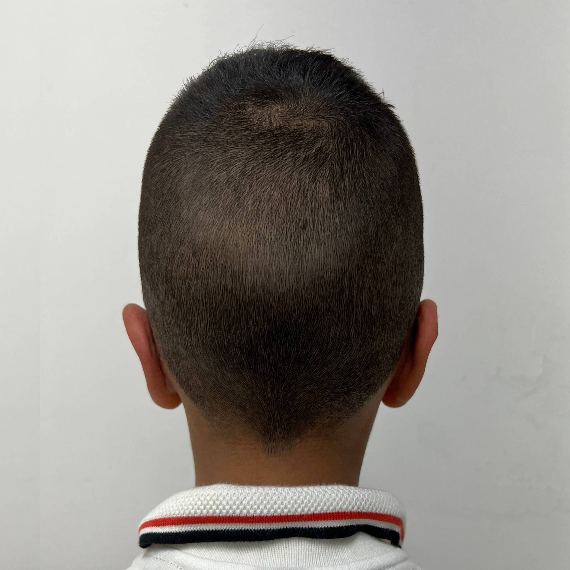 Otoplastia o Cirugía de Orejas – después del procedimiento | Dr. Alejandro Lozano, cirujano plástico en Neiva