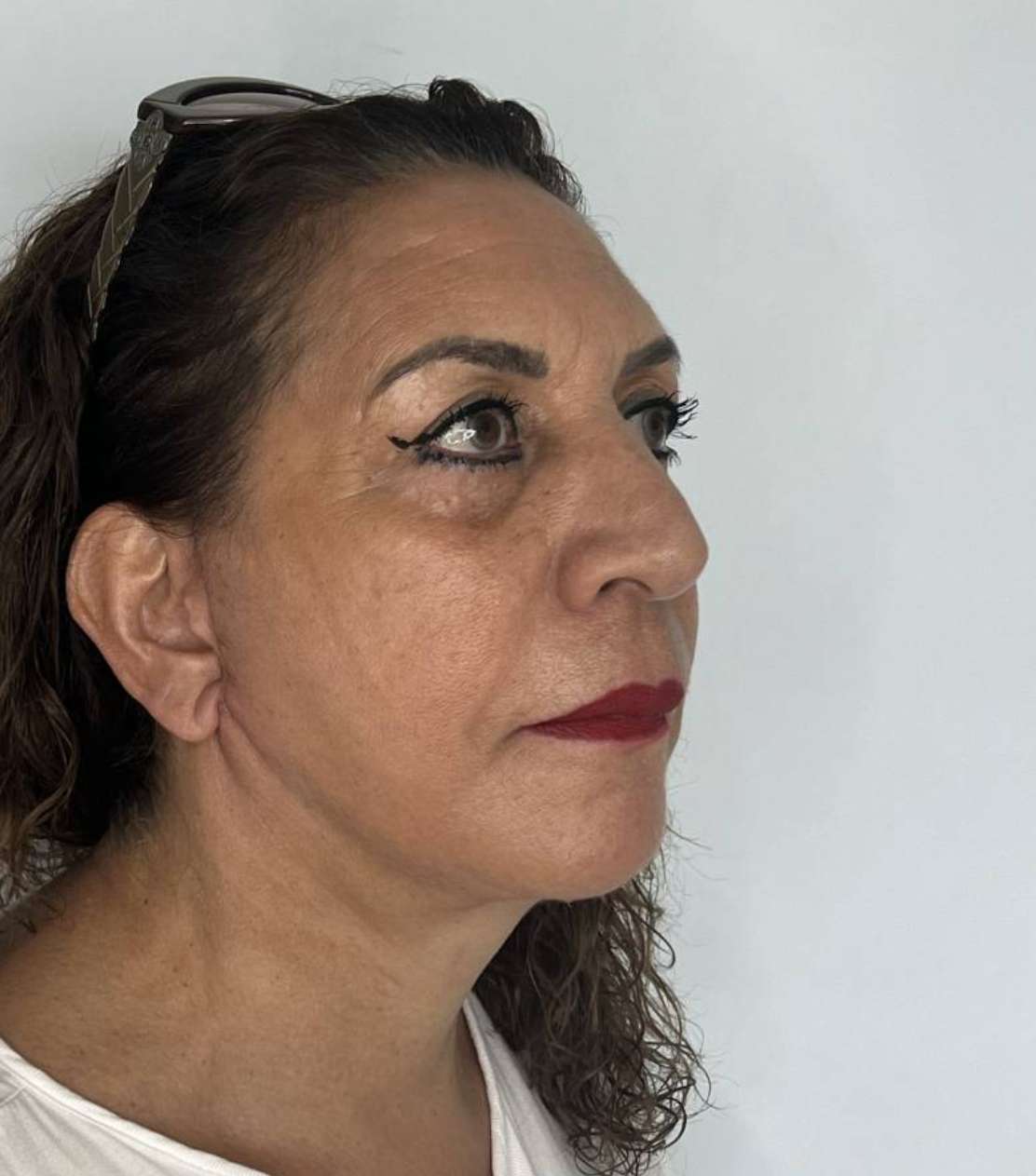 Ritidoplastia o lifting facial – antes del procedimiento | Dr. Alejandro Lozano, cirujano plástico en Neiva