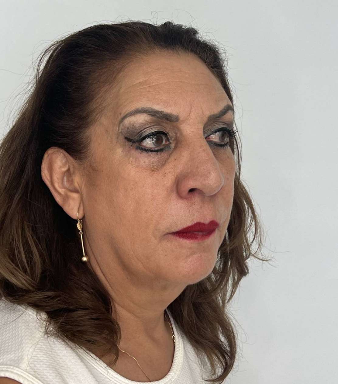 Ritidoplastia o lifting facial – después del procedimiento | Dr. Alejandro Lozano, cirujano plástico en Neiva