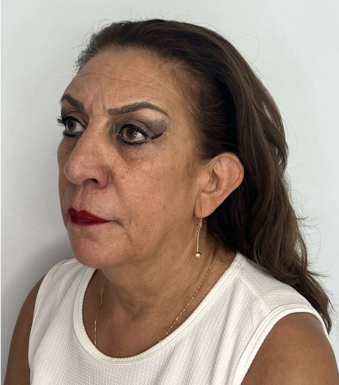 Ritidoplastia o lifting facial – después del procedimiento | Dr. Alejandro Lozano, cirujano plástico en Neiva